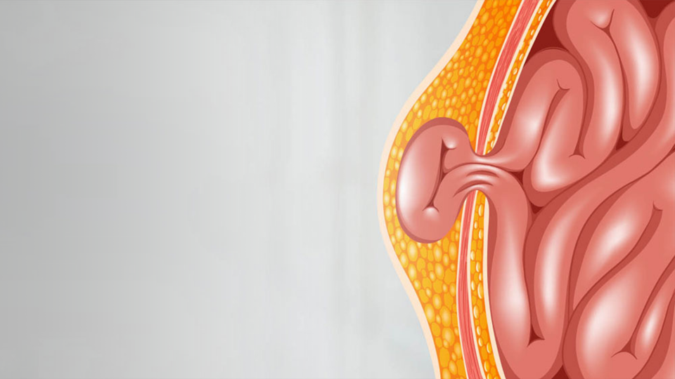 Inguinal Hernia in Infants & Children