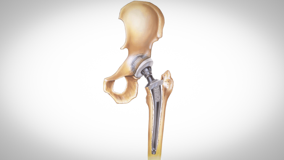 Prosthetic revision surgery