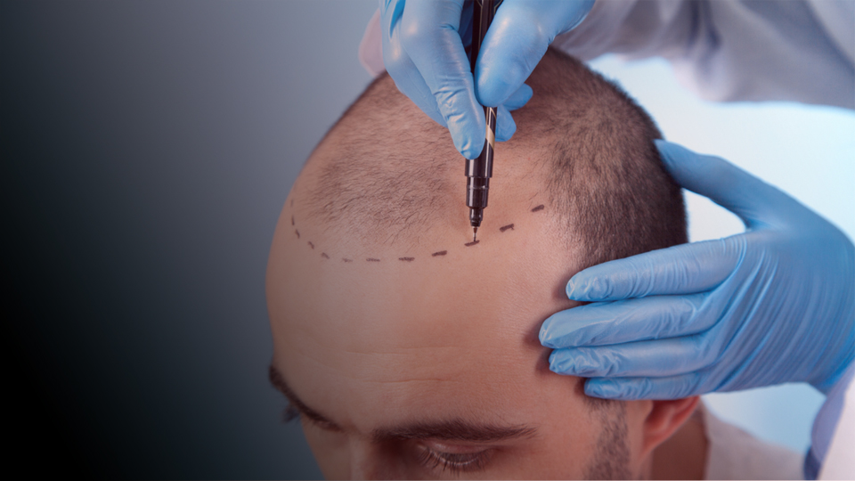 زراعة الشعر