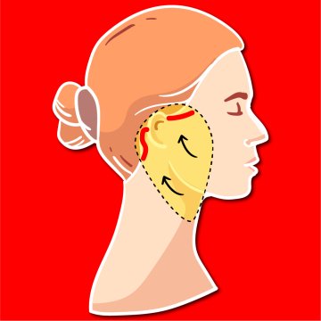 Komplettes Facelift (Traditionelles Facelift)