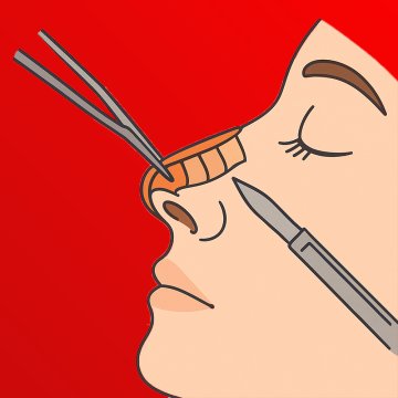 Offene Rhinoplastik