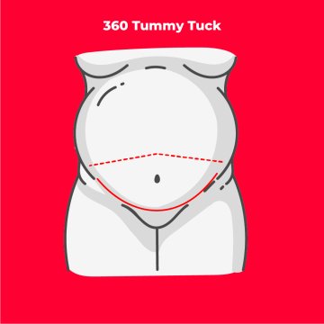 360 Tummy Tuck
