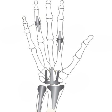 Arthroplasty (Joint Replacement)