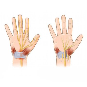 Carpal Tunnel Release