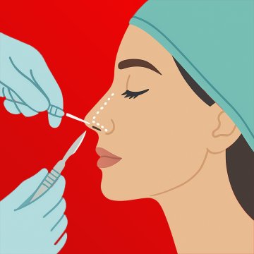 Geschlossene Rhinoplastik