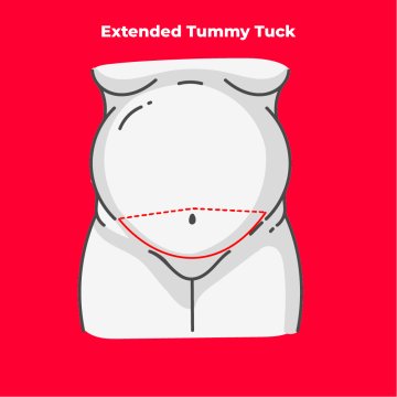 Extended Tummy Tuck