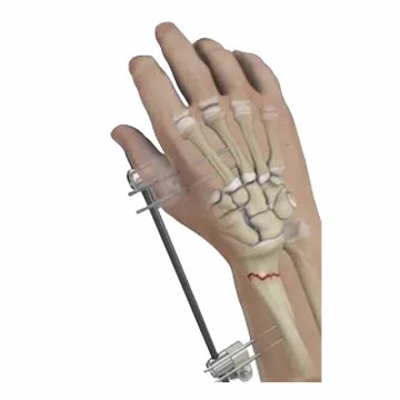 Frakturstabilisierungsoperation