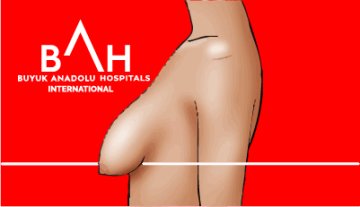 2. Derece Orta Derecede Ptozis