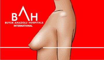 1. Derece Hafif Ptozis