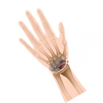 Fracture Fixation (Hand & Wrist)