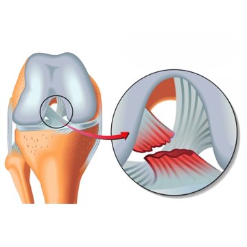 Ligament Reconstruction