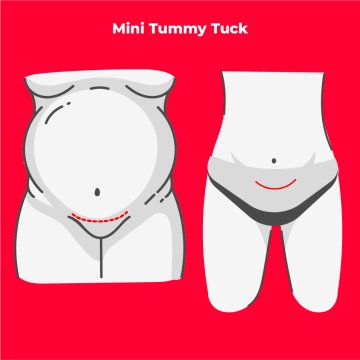 Mini Tummy Tuck