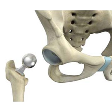 Partieller Hüftgelenkersatz (Hemiarthroplastik)