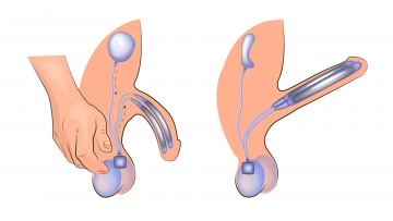Penis İmplantları