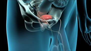 Prostatektomi