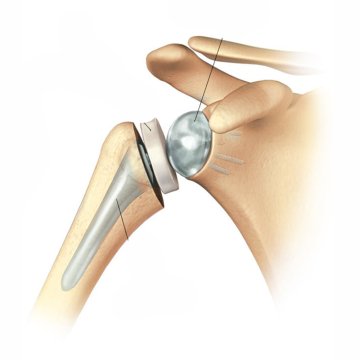 Schultergelenkersatz (Arthroplastik)
