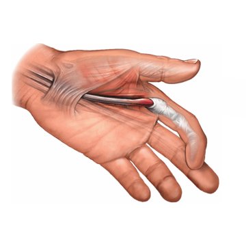 Trigger Finger Release