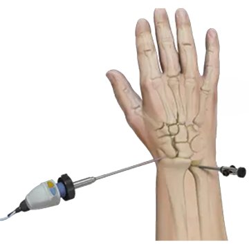 Wrist Arthroscopy