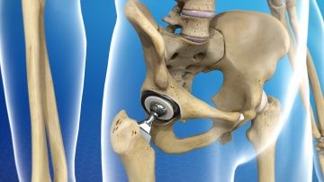 Arthroplasty