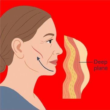 Deep-Plane-Facelift (Tiefenebenen-Facelift)
