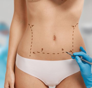 Liposuction (Yağ Aldırma)
