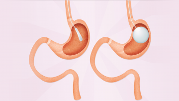 Воздушный шар для желудка