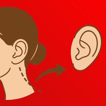 Otoplasti (Kulak Estetiği Ameliyatı)
