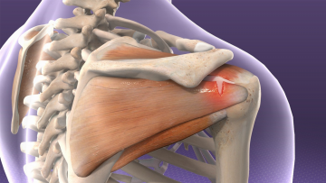 Rotator cuff repair