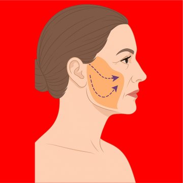 SMAS-Facelift (Superfizielles muskuloaponeurotisches System)