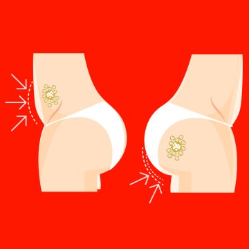 Geleneksel Liposuction BBL