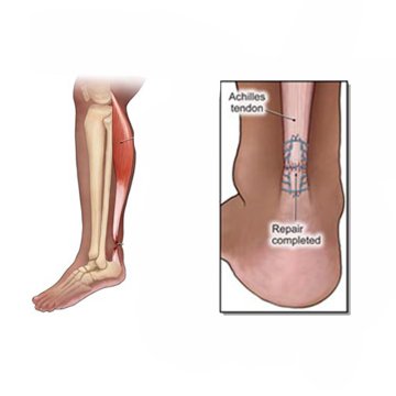 Tendon Repair Surgery