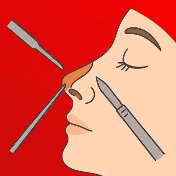 Tipplastik (Operation der Nasenspitze)