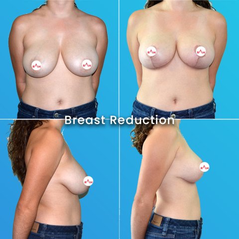 Breast Reduction Surgery: Before After image 1