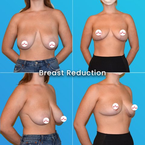Breast Reduction Surgery: Before After image 1