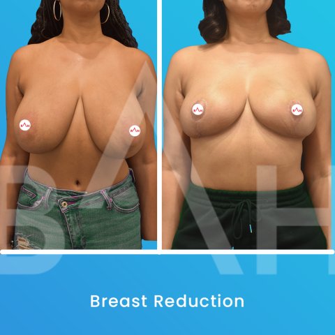 Breast Reduction Surgery: Before After image 1