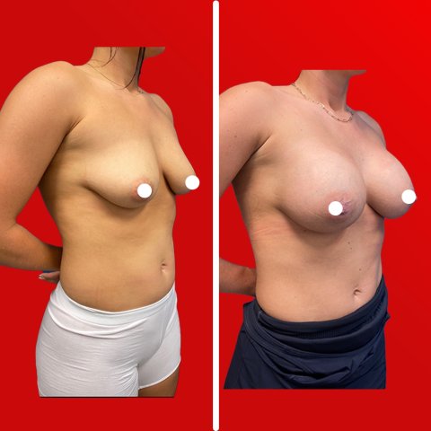 Breast Augmentation Before After image 1