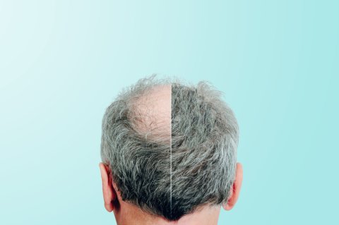 Hair Transplant in 20 Questions image 1