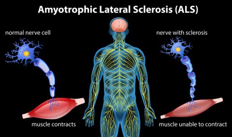 What is ALS? What are the stages and causes of ALS? image 1