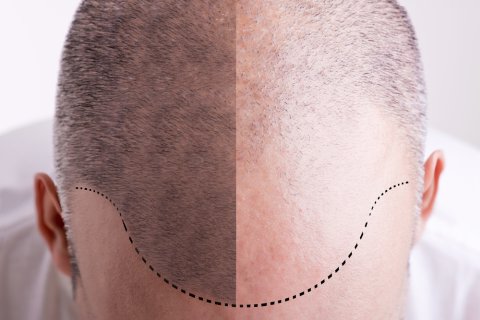 Hair Transplant in 20 Questions image 1