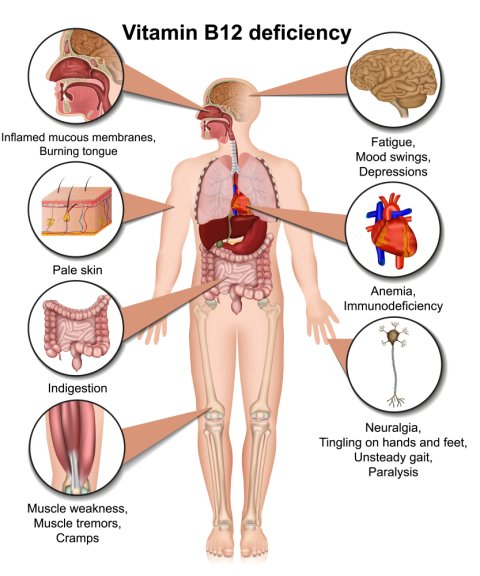 Vitamin B12 Deficiency: Causes, Symptoms and Treatment image 1