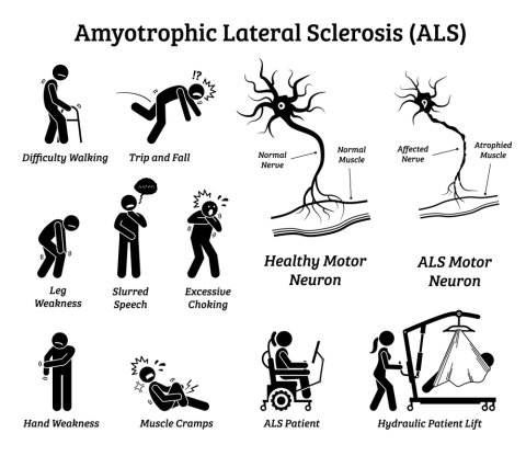 What is ALS? What are the stages and causes of ALS? image 1